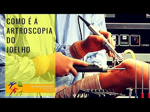 Vídeo: Artroscopia De Joelho
