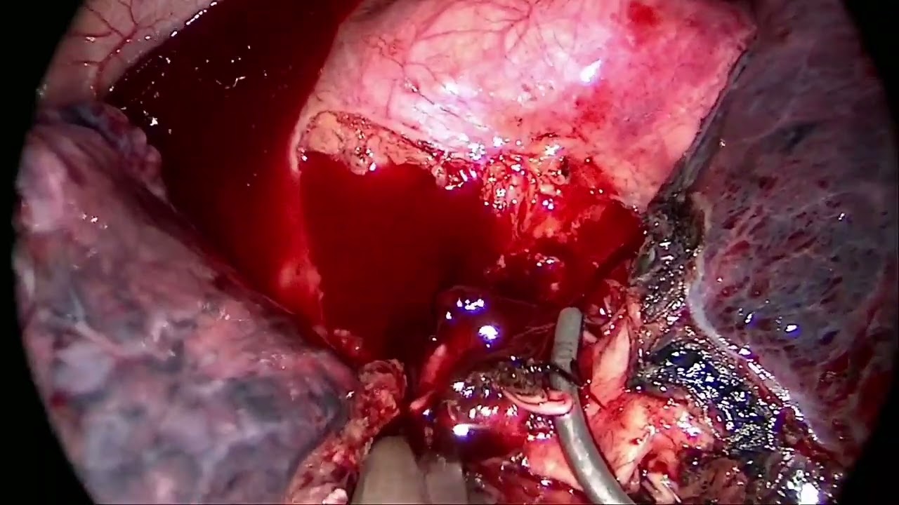 Uniport left upper lobectomy (lymphatic dissection + pulmonary angioplasty) 单孔左上肺切除术(淋巴清扫+肺动脉成形术)