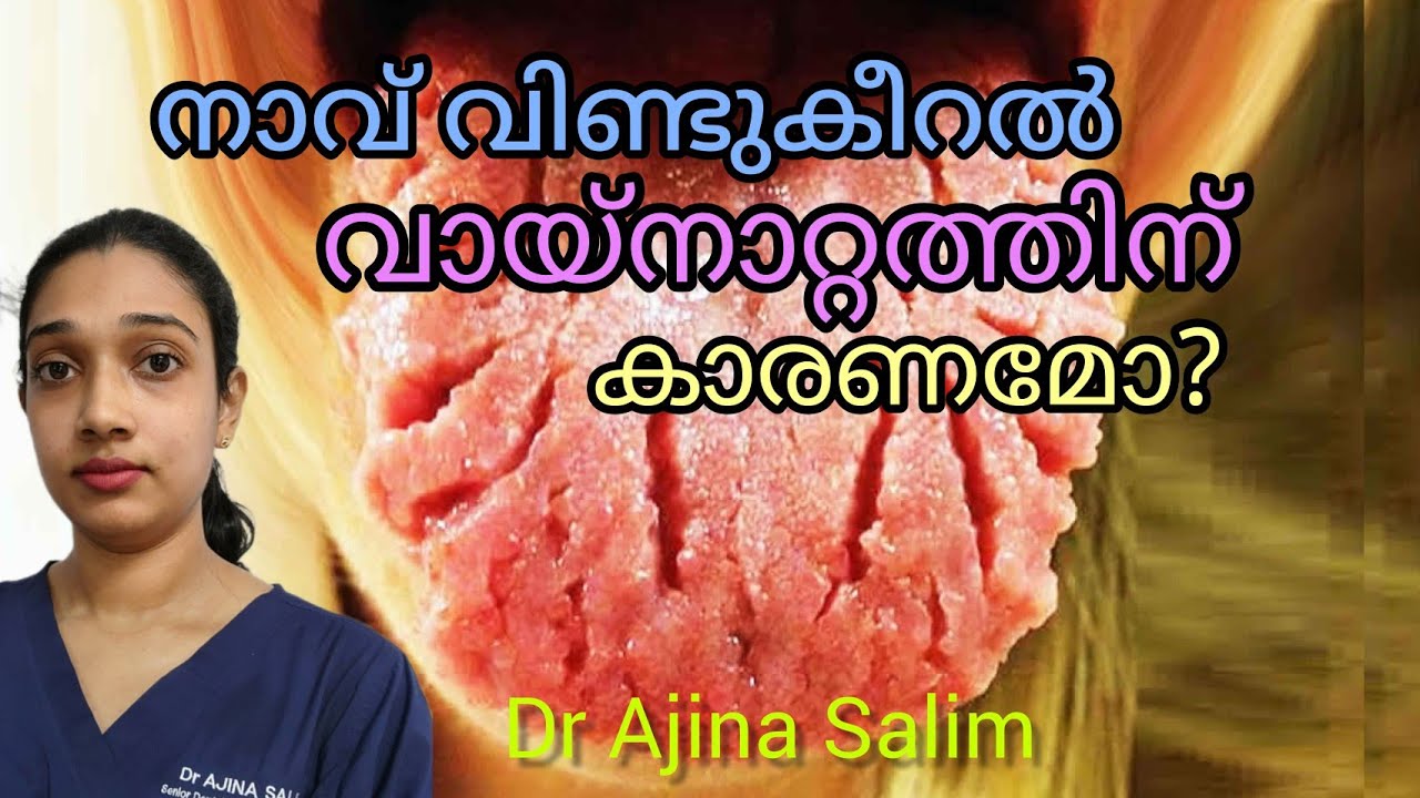 Fissured Tongue in Malayalam | നാവ് വിണ്ടുകീറൽ | Dr Ajina Salim