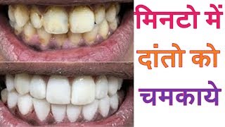 2 मिनट में गंदे पिले दाँतों को मोतियों की तरह सफेद बना देगा ये नुस्खा  : Jadi Buti Health Tips