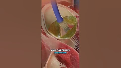 Replacing a valve in your heart (3D animation)