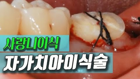 치아 빠지면 임플란트? 자가치아이식술/치아재식술