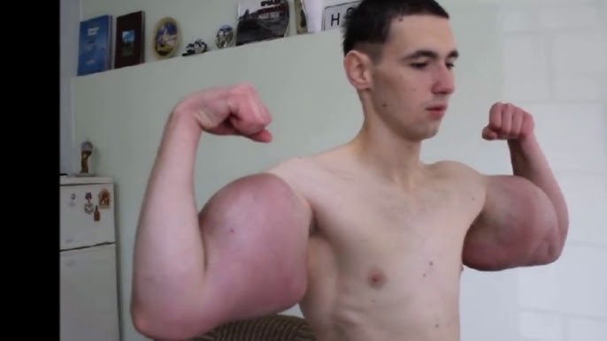 Synthol Kid gets his arms drained 