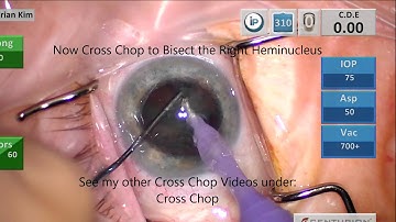 Double Chop: Efficient Modified Phaco Chop Technique, Medium pupil