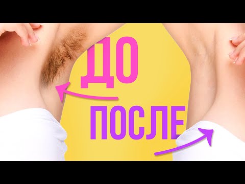 ВОЛОСЫ НА ТЕЛЕ: КАК УДАЛИТЬ НАВСЕГДА