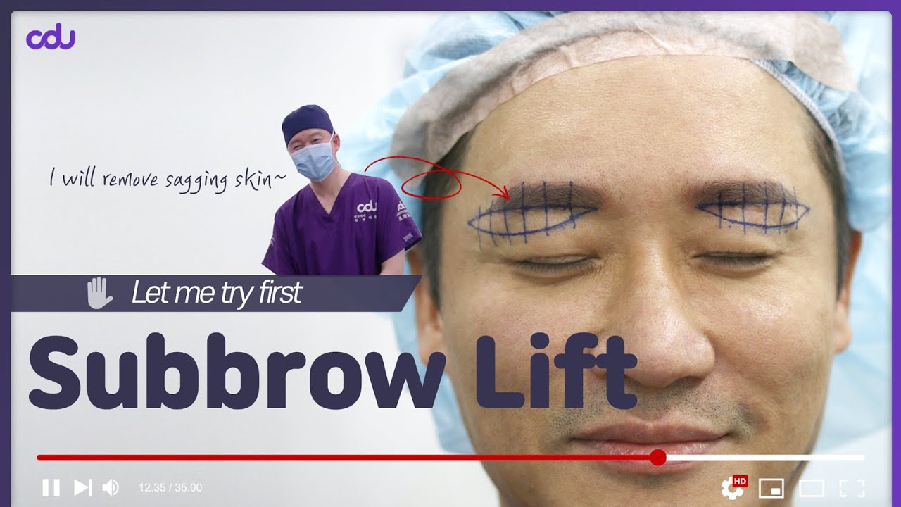 Dr. Yang Tried Anti Aging Eye Surgery in Korea [Kor/Eng Sub]