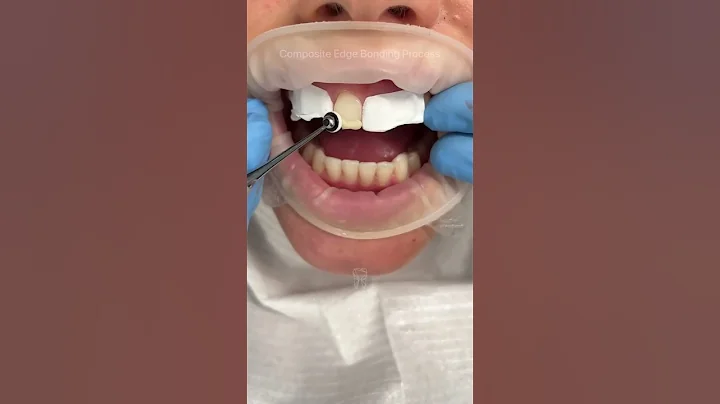 Composite edge bonding to create symmetry of the teeth 🤍✨