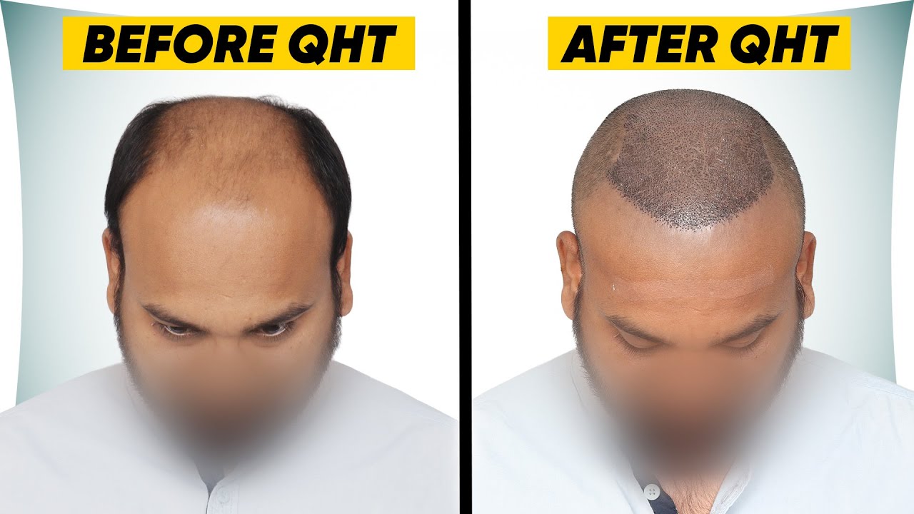 Hair Transplant in Kochi (HX-TPGj) | Best Results & Cost of Hair Transplant in Kochi