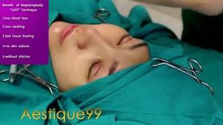 ตาสองชั้น เลเซอร์ 