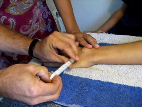 Video: Hygrom Der Hand - Behandlung, Hygrom Des Handgelenks Der Hand