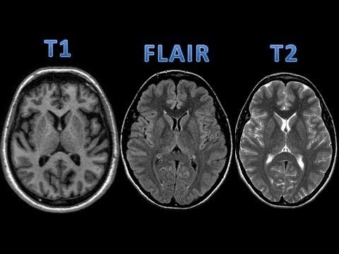 MRI t2 - YouTube