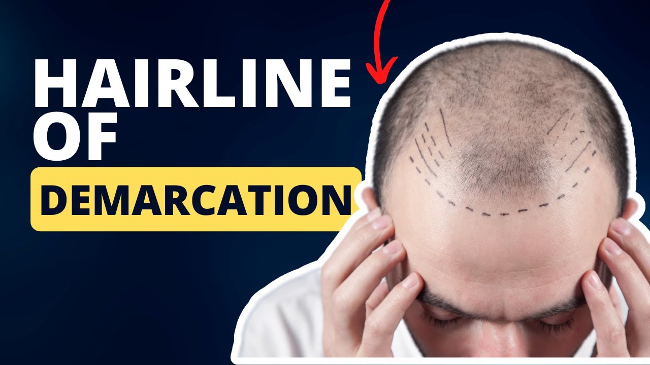 EP. 3179:  The Hairline of Demarcation