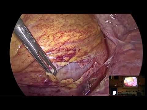 ASST Mantova Live surgery:  Epicardial CRT - Andrea Droghetti