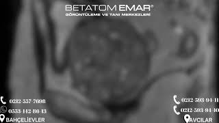 Prostat Mr Prostate Mri - Betatom Emar