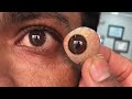 3d artificial eye made by ocularist ravikant sharma in phthisis bulbai case