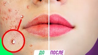 УЖАС! ПРЫЩИ! ПРОВЕРЕННЫЕ ЛАЙФХАКИ КАК ИЗБАВИТЬСЯ ОТ ПРЫЩЕЙ ЗА ОДНУ НОЧЬ УЖАС! ПРЫЩИ! ПРОВЕРЕННЫЕ ЛАЙФХАКИ КАК ИЗБАВИТЬСЯ ОТ ПРЫЩЕЙ ЗА ОДНУ НОЧЬ