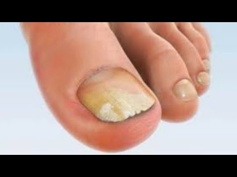 poate fi îndepărtată ciuperca unghiilor cum să dezinfectați pantofii de ciuperca unghiilor cu oțet