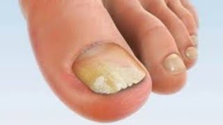 Ciupercă unghie picior - tratamente și sfaturi