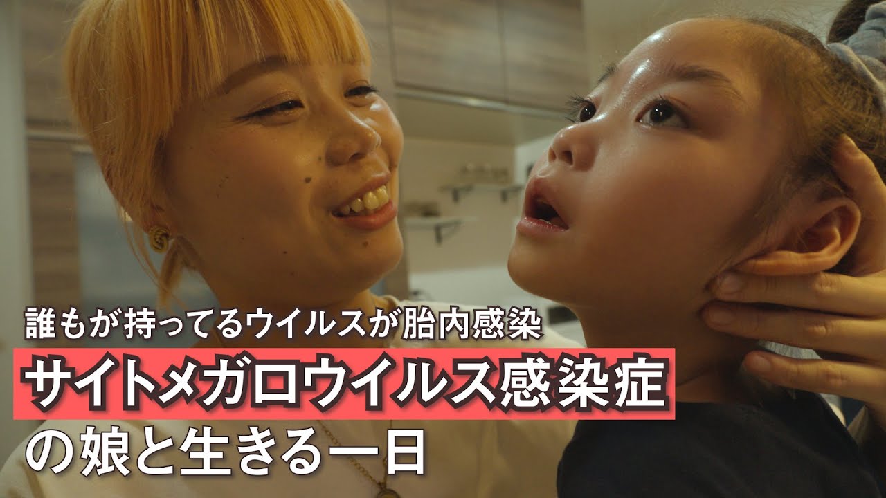 【サイトメガロウィルス感染症】稀少な障がいを持つ娘を育てるシングルマザーの一日 supported by にしたん ARTクリニック #にしたんARTクリニック#ジャパンバリアフリープロジェクト#障害