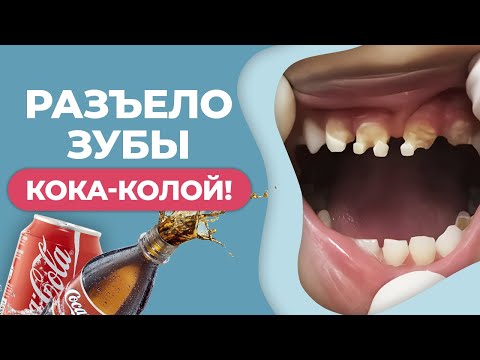 Что делает кока-кола с зубами? / Вред колы для зубов