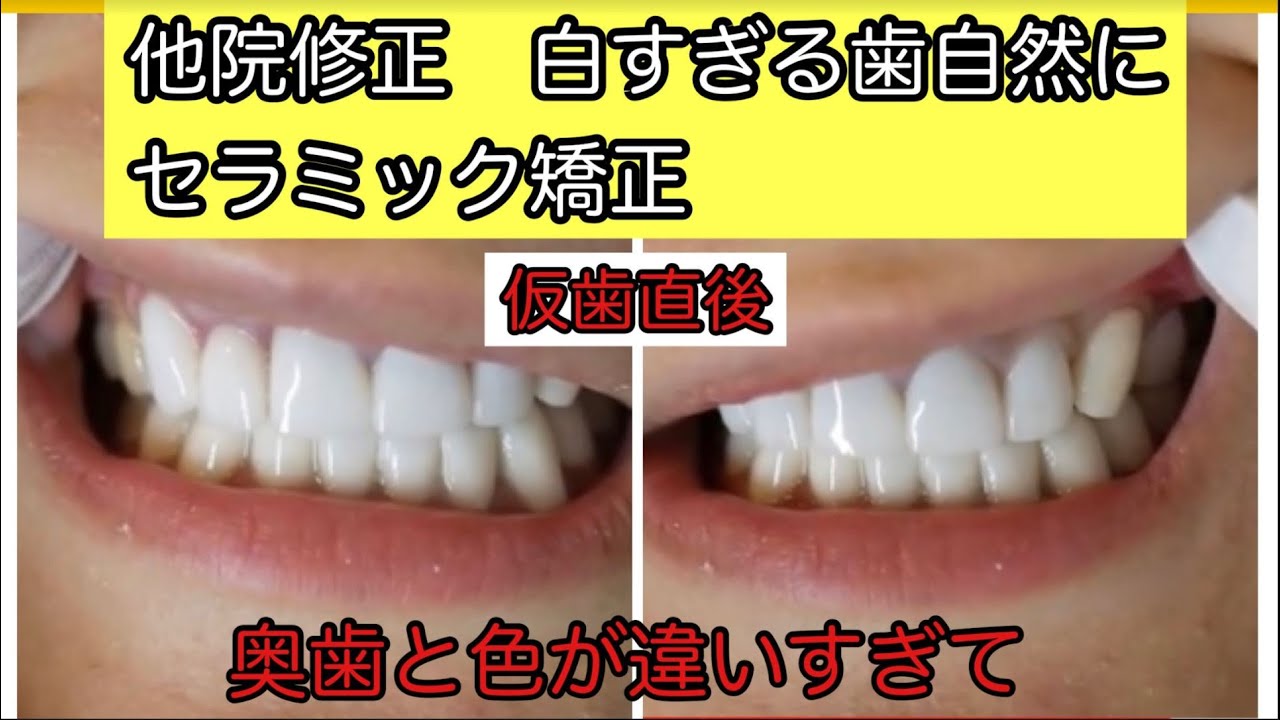 セラミッククラウン 白すぎる歯 他院修正 2 2 Youtube
