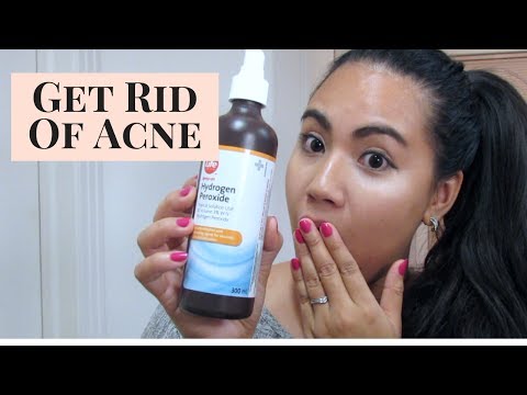 How to treat your acne using hydrogen peroxide?