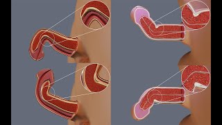 Why Peyronie's Disease Causes Penile Curvature in Different Directions
