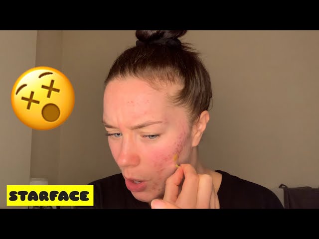 Starface Pimple Patches Review: How They Work on Breakouts