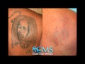 Will Laser Tattoo Removal Scar