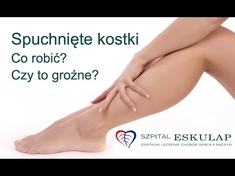 Opuchnięte kostki nóg - jak leczyć i zapobiegać?