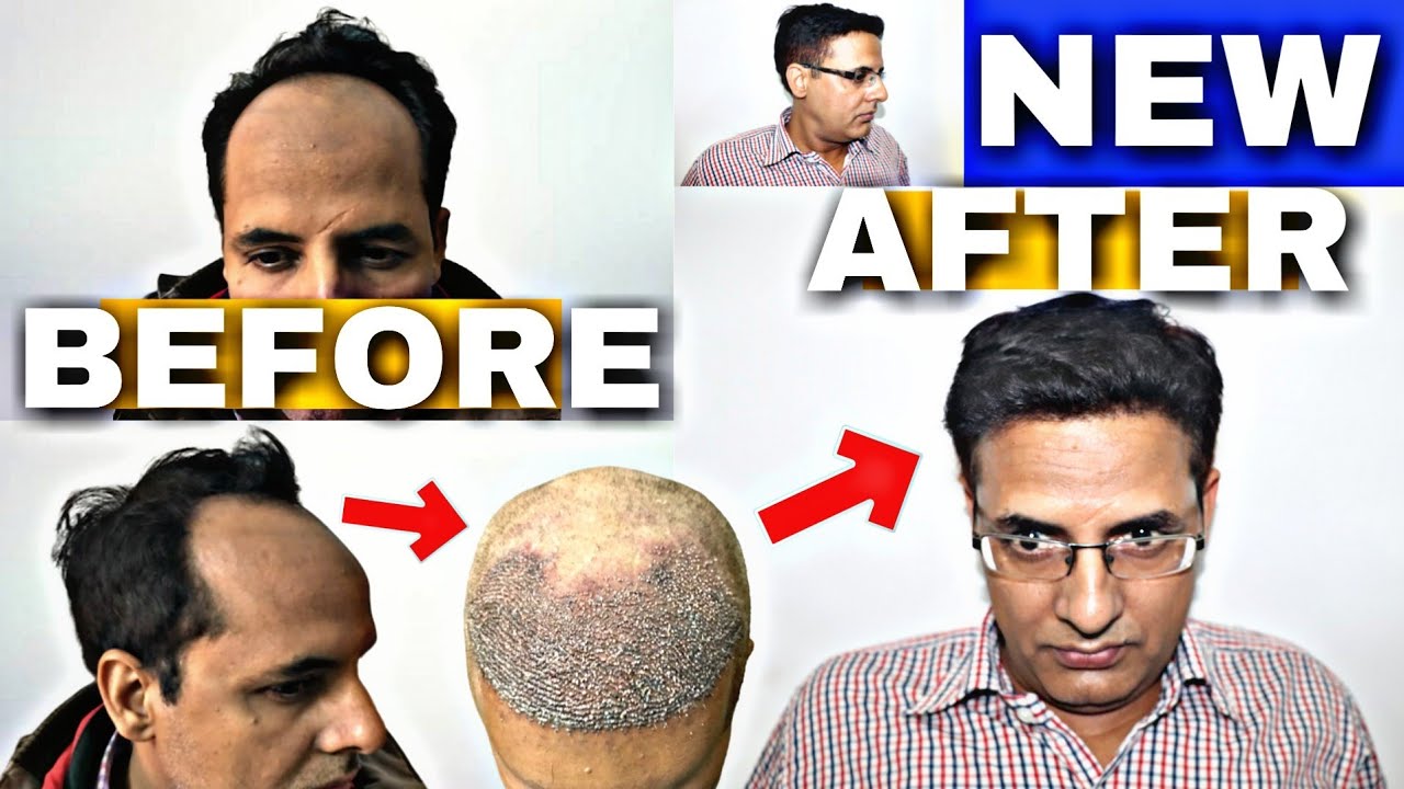 Get Hair Transplant Results in Dehradun Uttarakhand India