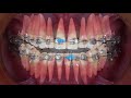 Clinical tip midline correction with intermaxillary elasticschris chang orthocc451