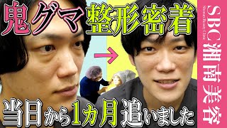 【目の下のクマなくす整形】腫れやダウンタイムはこんな感じでした【メンズ・男性クマ取り】湘南美容クリニック