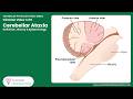 1/6 video- Cerebellar Ataxia: Definition, History and Epidemiology