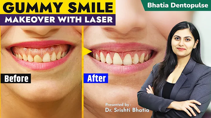 GUMMY Smile Makeover with Dental LASER & Zirconia Crowns: Dr. Srishti Bhatia #smile #smiledesign