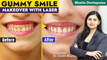 GUMMY Smile Makeover with Dental LASER & Zirconia Crowns: Dr. Srishti Bhatia #smile #smiledesign