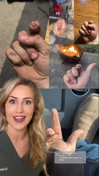 What to do if you accidentally cut off your finger