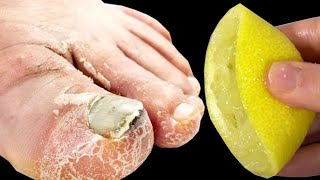 Cure Toenail Fungus For Less Than $1 in under 2 minutes You must do it