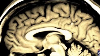 Health Headlines: Spring Break Safety & Brain Injury Awareness