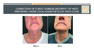 Correction of Turkey Gobbler Deformity of neck performed under local anaesthetics at MACS Clinic