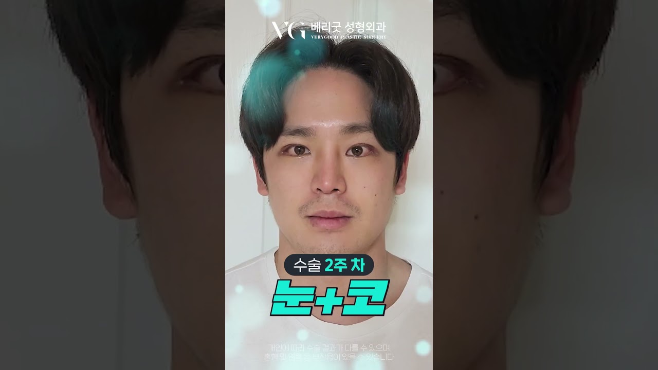 [Bệnh viện phẫu thuật thẩm mỹ Verygood] Trước và sau phẫu thuật mắt + mũi, đúng là cùng một người sao? 🥰 #Thẩm mỹ viện Gangnam #Phẫu thuật mắt Gangnam #Phẫu thuật mũi Gangnam #Bệnh viện thẩm mỹ Verygood #Phẫu thuật tạo mắt hai mí #Phẫu thuật mũi #Ngủ ngon cô gái #YareYare #Cô gái không thể ngừng nói