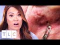 Dr. Lee Removes Multiple Blackheads From Patient's Face | Dr. Pimple Popper: This Is Zit