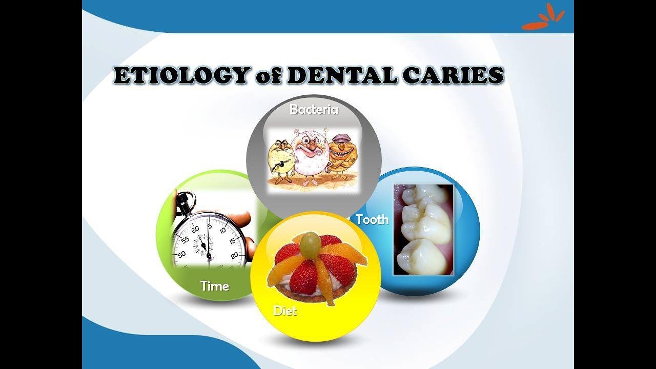 Dental cariesEtiology and Pathogenesis YouTube
