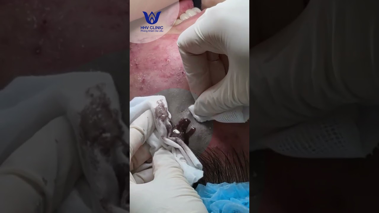 Nặn mụn áp xe vùng thái dương.