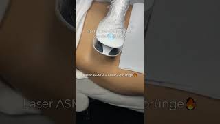 ★ Laser-Haarentfernung Ergebnis | 3 ★ #laserhaarentfernung #mediostar #electroepilangels #epilation