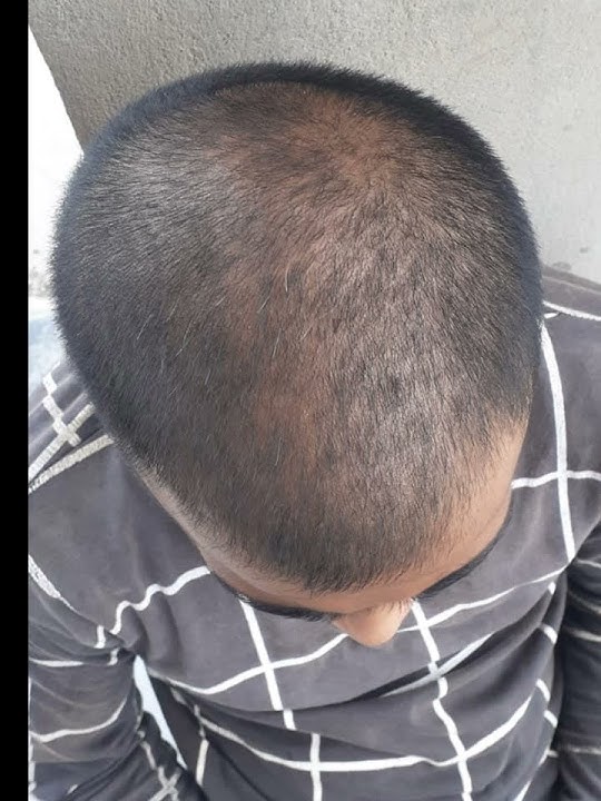 Minoxidil 5% using 8 month hair growth results