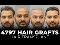 Sapphire hair transplant results  before after