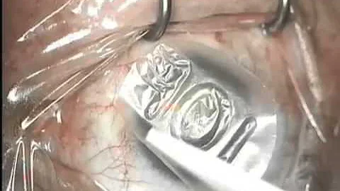 Explant of ProKera - Replacement with AmbioDisk