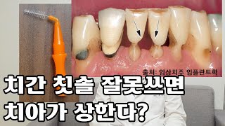 잇몸병에 효과적인 칫솔질(8): 치간칫솔시 꼭 알아야 할 3가지 포인트