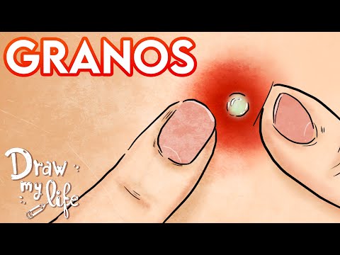 Video: ¿Los granos desaparecen solos?